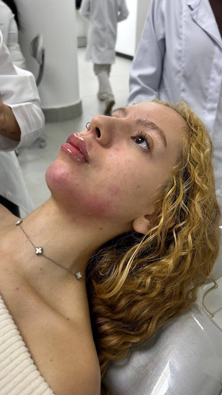 Registro imediato após preenchimento labial na ÉLEVÉ Clinic