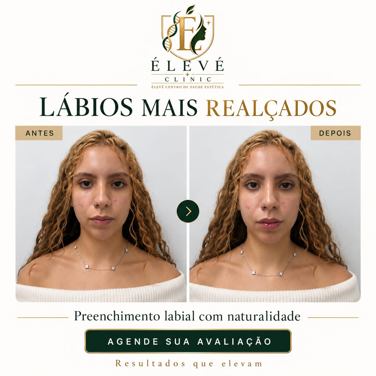 Arte da ÉLEVÉ Clinic com comparativo de preenchimento labial
