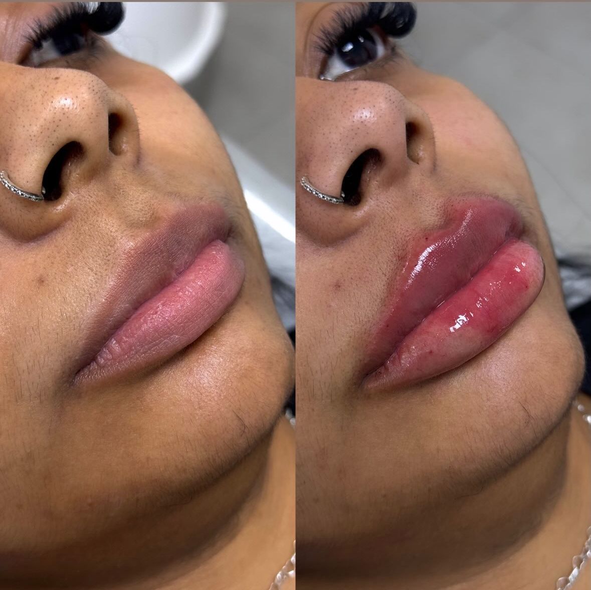 Comparativo de preenchimento labial em perfil na ÉLEVÉ Clinic