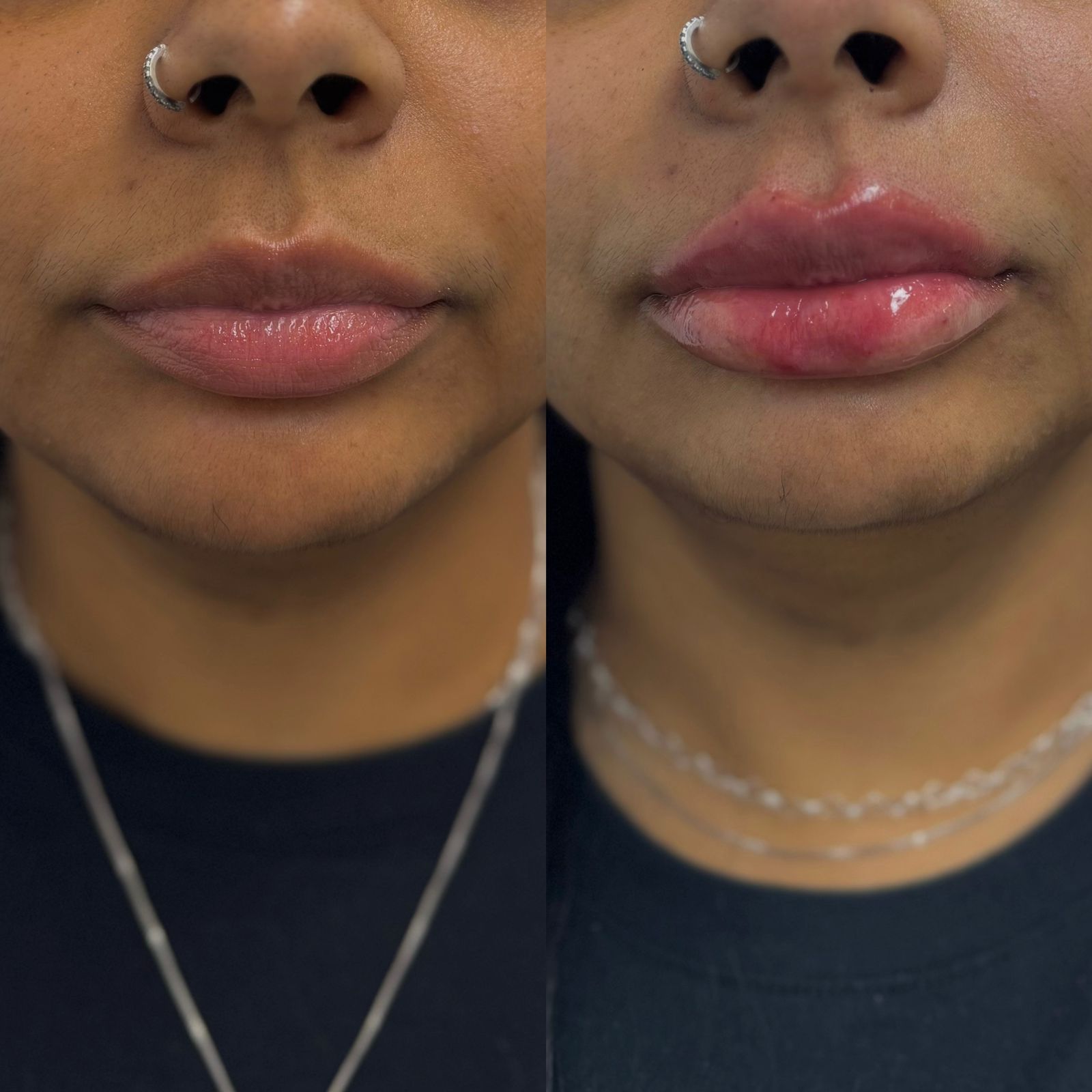 Comparativo frontal de preenchimento labial na ÉLEVÉ Clinic