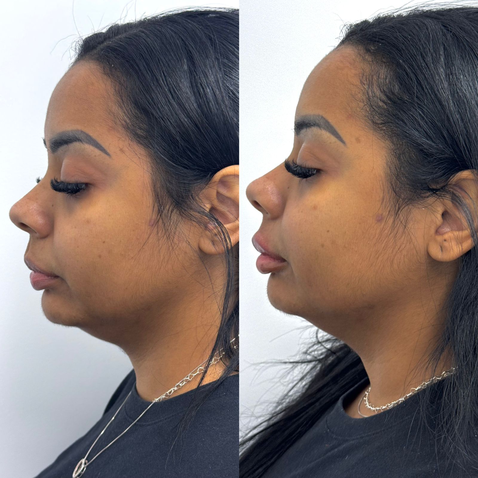 Comparativo facial em perfil de paciente atendida na ÉLEVÉ Clinic