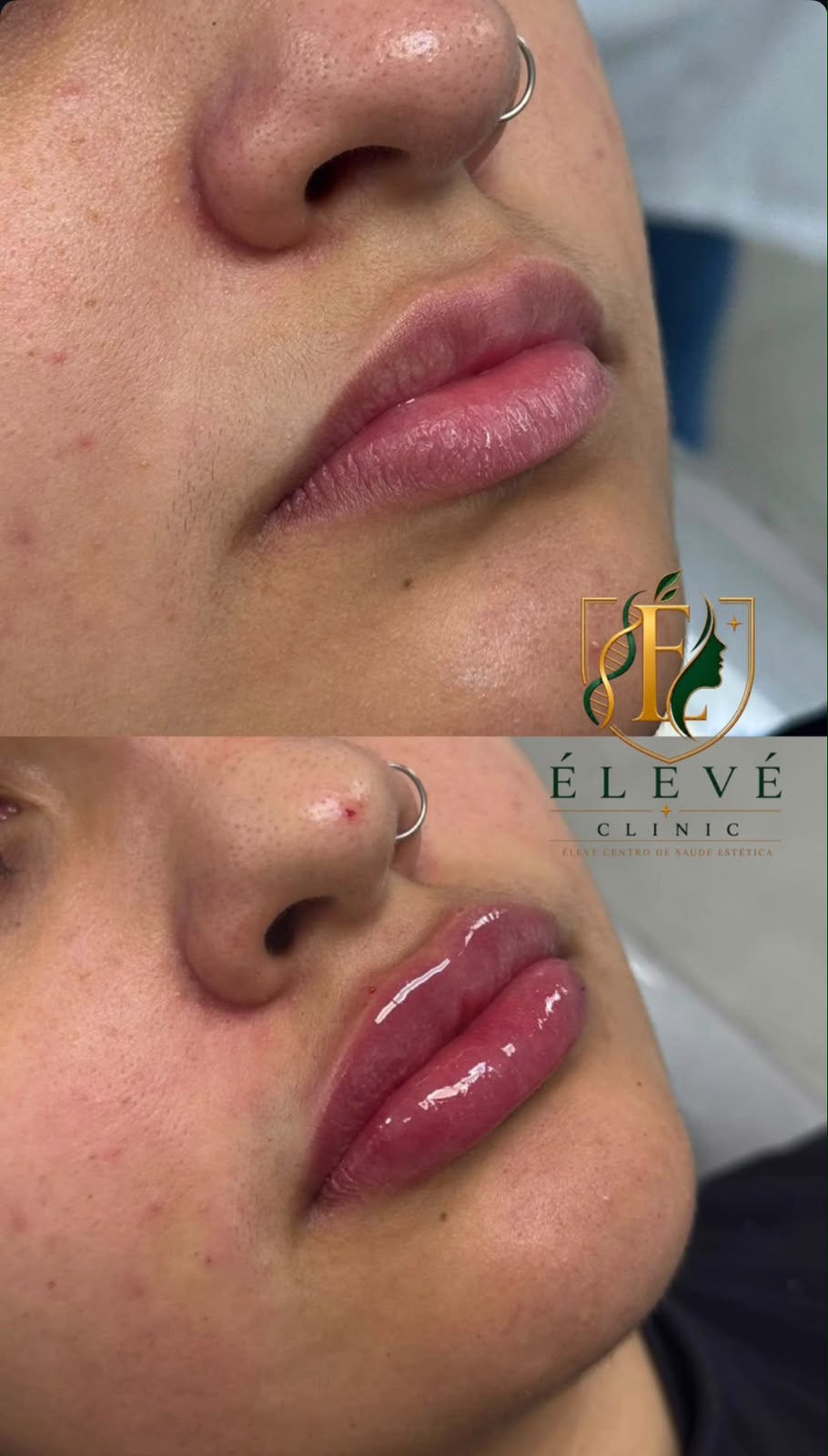Registro de preenchimento labial com identidade ÉLEVÉ Clinic